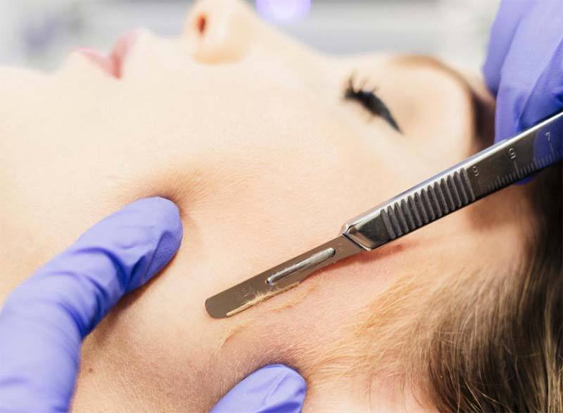 dermaplaning-1