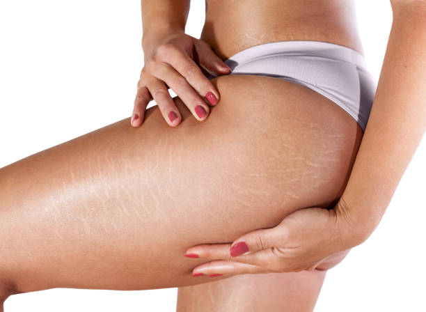 Stretch marks on woman's thighs and buttocks